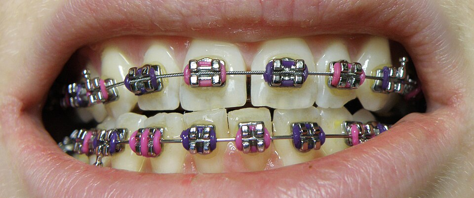 Government-Covered Braces